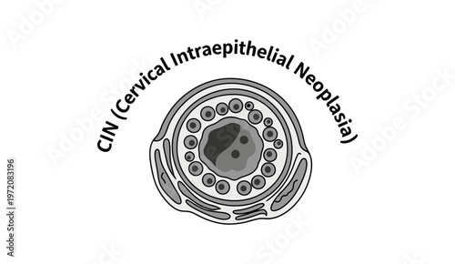 Medical Illustration of Cervical Intraepithelial Neoplasia (CIN) Cell in Black and White.