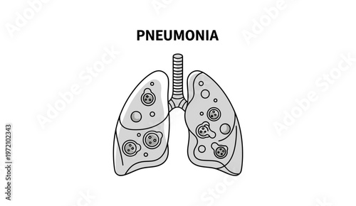 Pneumonia Disease Illustration - Infected Human Lungs Concept