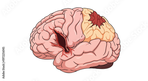 Illustration of a human brain with a visible injury and damaged tissue on the frontal lobe area