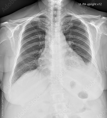 Medical Chest X-ray Showing Pulmonary Pleural Effusion with Visible Fluid Accumulation and Costophrenic Blunting.