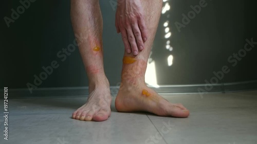 Painful close up of man gently touching severe second degree burns with large blisters on leg and ankle, showing painful skin injury and need for medical treatment. Burns on legs of man.