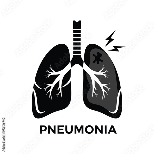 A stark black and white illustration depicts human lungs affected by pneumonia showcasing inflammation and infection high quality professional