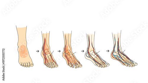 Medical diagram showing the progression of inflammation or injury in a human foot from surface redness to deep vascular changes.