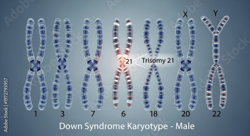 Detailed scientific illustration depicting a human male karyotype with an extra chromosome 21, characteristic of Trisomy 21, the genetic cause of Down Syndrome