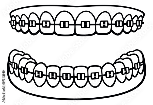 Line art dental braces set featuring upper and lower orthodontic braces for dentistry and healthcare concepts