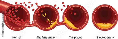 This illustration depicts the progression of atherosclerosis showcasing a normal artery versus increasingly blocked vessels with plaque buildup high quality professional detailed modern