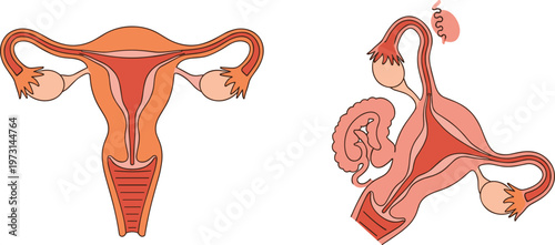 An illustrative comparison depicts a normal uterus and fallopian tubes alongside a uterus affected by endometriosis high quality professional detailed modern elegant stylish