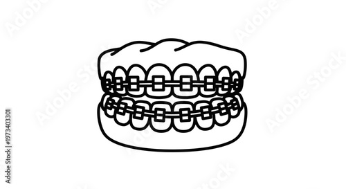 Dental Braces on Teeth - Orthodontic Treatment for Straightening Teeth