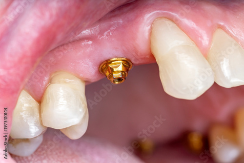 Tableau sur toile Close-up of dental implant healing abutment in gum