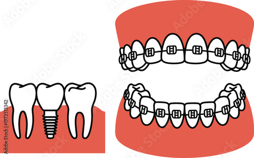 Dental Health: Tooth Implant and Braces