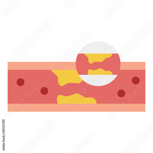 Atherosclerosis Illustration: Plaque Buildup in Artery