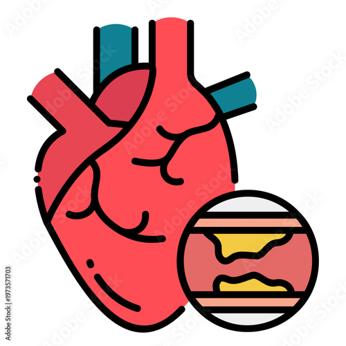 Heart with Atherosclerosis Illustration