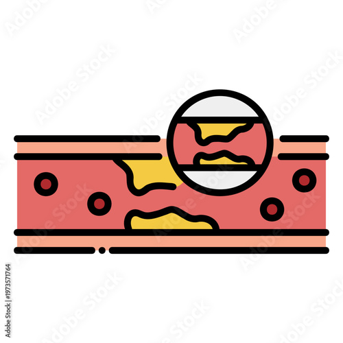 Atherosclerosis: Plaque Buildup in Artery Illustration