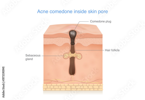 Acne comedones and blackhead formation in a clogged skin pore, Sebum buildup inside the hair follicle. Medical illustration about skin layer with acne for beauty treatment.