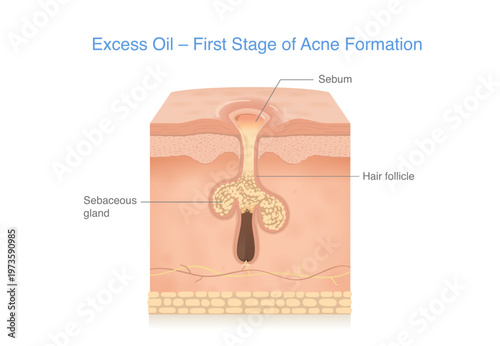 Excess oil buildup clogged in a skin pore, the first stage of acne formation in human skin. Medical illustration of sebum inside a skin pore layer of oily skin people.
