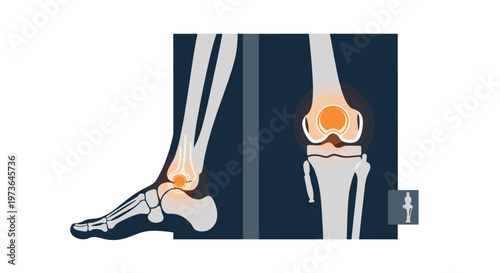 Detailed anatomical diagram of human ankle and knee joints displaying inflamed orange circular regions within a clinical medical illustration on dark background.