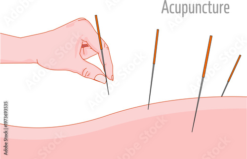 Acupuncture, alternative treatment. Hand holding chinese needle. Illustration vector