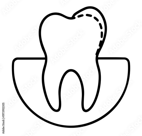 Tooth Enamel Reshaping Odontoplasty, Uneven Cutting Edge Correction with Dental Contouring