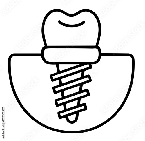 Dental Implant Placement with Screw and Crown, Tooth Replacement and Jaw Restoration Procedure
