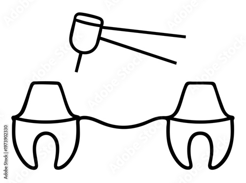 Tooth Preparation for Dental Bridge, Grinding Adjacent Teeth for Prosthetic Support