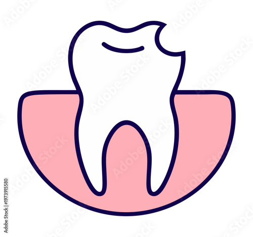 Deep tooth decay cavity on chewing surface — caries destruction requiring filling or restoration, dental treatment