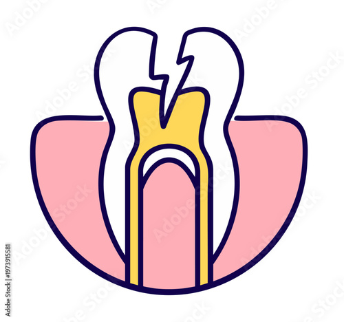 Severe cracked tooth reaching pulp — vertical fracture of crown and root causing nerve damage, dental emergency treatment