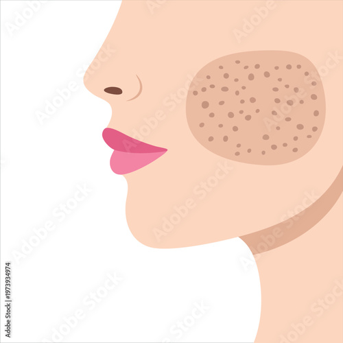 Bad Condition Of Cheek With Clogged Pore Trouble Vector Art For Dermatology
