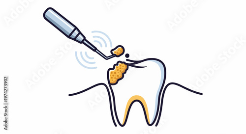 Dental tool cleans tooth plaque