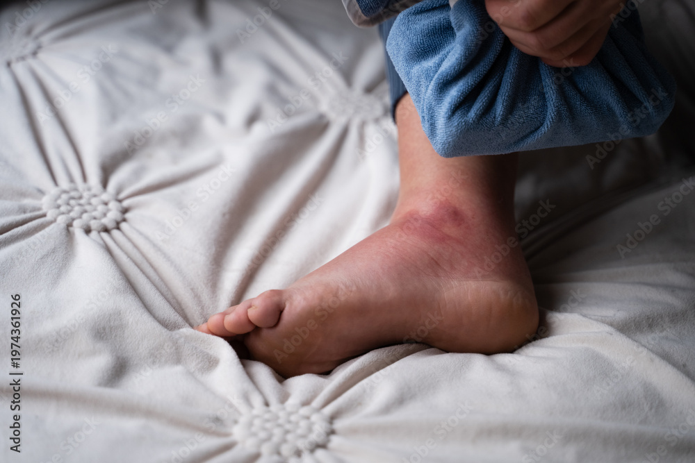 Foto Ankle injury