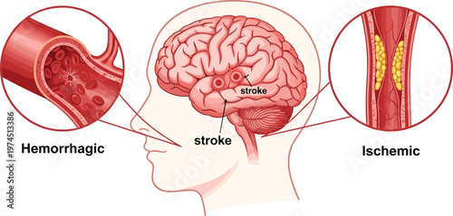 Human brain stroke illustration, ischemic stroke blockage, hemorrhagic stroke bleeding, medical anatomy diagram, neurology healthcare concept, flat vector illustration