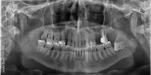 Panoramic dental x ray showing teeth and jawbone