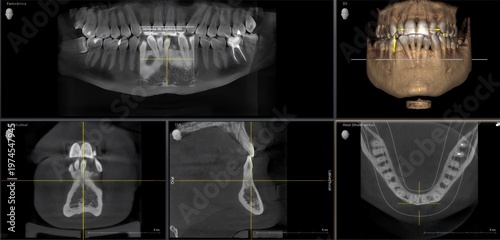 Canvastavla Dental cbct scan showing jaw and teeth analysis