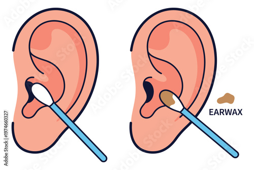 Cartoon illustration of ear cleaning depicting cotton swab removing earwax for medical and hygiene design