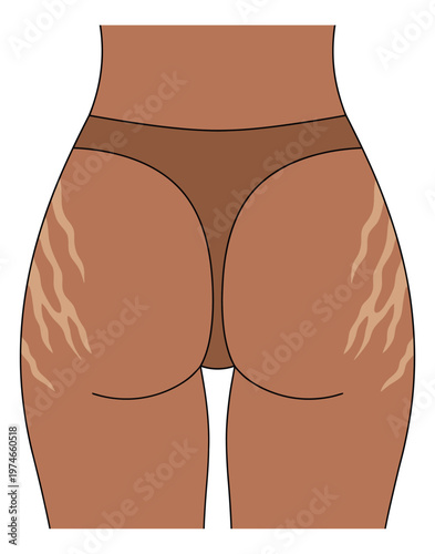 Flat illustration of female buttocks depicting stretch marks and skin texture for beauty and body care design