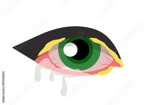 Bacterial conjunctivitis illustration. Hand-drawn vector clip art.