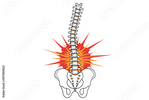 Illustration depicting a human spine with radiating pain lines emanating from the lower back area
