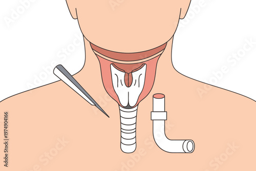 Anatomical illustration depicting a tracheostomy procedure with a surgical instrument and a tracheostomy tube high quality