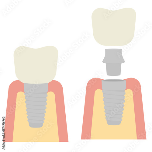 歯科治療のインプラントのイラスト