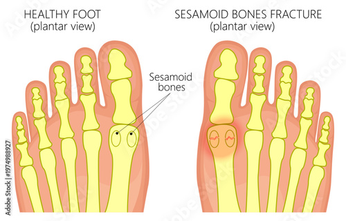 Healthy foot and a foot with Sesamoid boneS fracture
