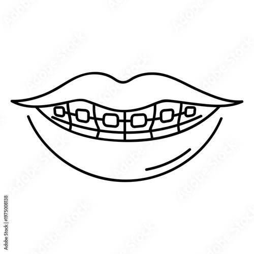 Mouth with braces smiling brightly