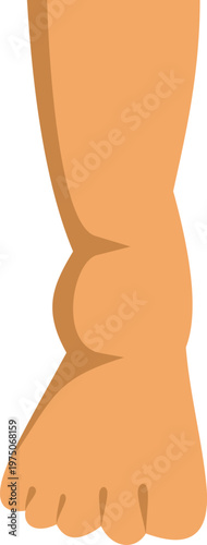 Human leg showing a swollen ankle and foot due to injury or medical condition