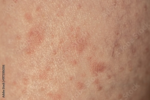 Skin with reddened spots, rash, allergy