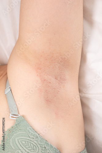 Smooth underarm after wax depilation showing mild redness and delicate texture. closeup of treated area. Esthetician aftercare skin tone detail