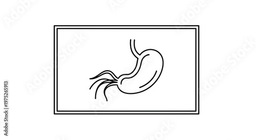 Helicobacter pylori bacteria infecting stomach lining, medical illustration