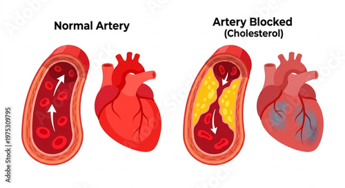 Normal Artery vs. Blocked Artery (Cholesterol) Heart Vector Comparison