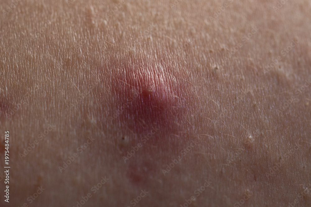 Fototapeta premium Macro shot of skin irritation with acne. Inflamed skin bumps acne macro. Detailed skin with acne. Skin rash texture with acne.