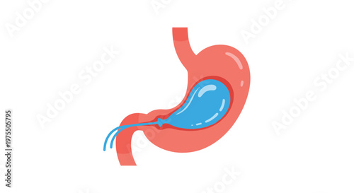 Medical illustration of a human stomach showing a blue intragastric balloon placed inside to aid in weight loss treatments.