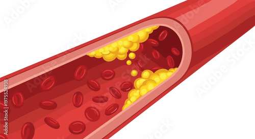 Cross section of a red blood vessel showing yellow cholesterol plaque buildup narrowing the passage for blood cells.