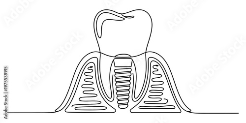 A continuous line drawing illustration of a dental implant placed in the gum and jawbone area Vector, illustration