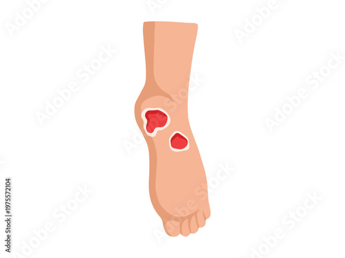 Diabetic Foot Ulcers